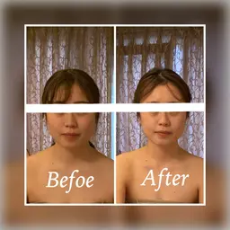 小顔矯正(モニター)×4回