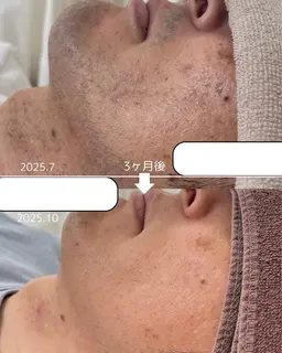 【ひげ脱毛】洗浄→毛穴角質ケア→吸引→脱毛照射→鎮静パック