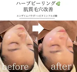 【圧倒的人気No1★】REVI剥離無しハーブピーリング+オプション2つ◎20900→¥8800