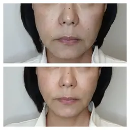 ✴️期間限定📣最新機器サーマトリックスで小顔💆ニキビ跡凹凸肌も改善✨シートマスク付き☝️