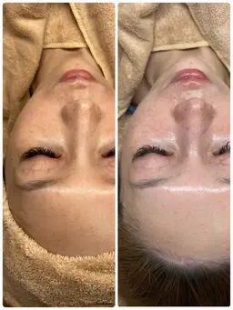 【2月末まで｜肌質チェック体験】カウンセリング＋REVIハーブピーリング（写真撮影あり）