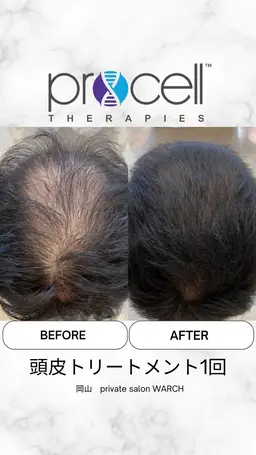 【本気の育毛促進】プロセル頭皮（頭頂部、円形の抜け毛）￥50,000→￥40,000