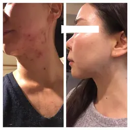 女性限定☀️夏の乾燥・ニキビ集中ケア