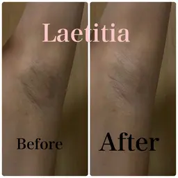 【特別キャンペーン価格✨1/31まで】ローマピンク🌸「Vライン、Oライン、脇、肘、膝、お尻」