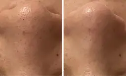 小顔フェイシャルケア＋毛穴洗浄付🫧60分