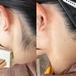 【水・木・金曜限定女性のみ✨】お顔剃り＋うなじシェービング