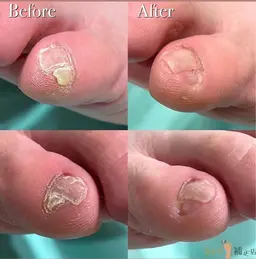 【副爪ケア】小指の爪横にある爪みたいなもの🌀キレイに除去し、痛みや違和感を改善💁‍♀️