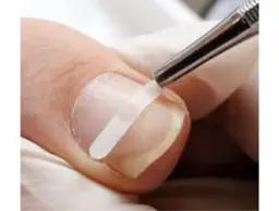 巻き爪矯正1本（フットネイル同時）