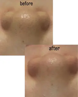 毛穴洗浄➕プラセンタ導入【お顔マッサージ付き✨】❗️