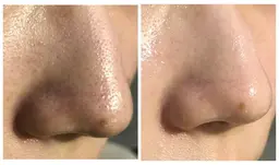 💎毛穴最強💎皮脂黒ずみ撃退❗️毛穴洗浄《顔+頭皮》60分5500円✨