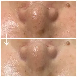 毛穴徹底洗浄エステ