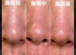 毛穴角栓洗浄吸引60分 【men’s】もok          13200→6600