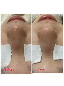 秋の毛穴🍂ポアレスラボ開発！毛穴洗浄後紫外線を浴びたダメージ肌にビタミン誘導体VCエチル配合美容液をエレクトロ導入⭐️