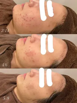 【リピーター様限定】ハーブトリートメント🌿(剥離なし)+鎮静パック+イオン導入🍋ビタミンCを肌奥まで浸透