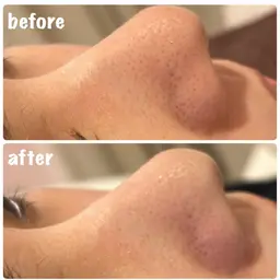 〈🎀モニター様限定価格🎀〉大人気ハイドラフェイシャル(毛穴洗浄)✨