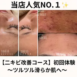 人気NO1【肌質改善】ハードハーブピーリング🌿ニキビ.ニキビ跡.クレーター.毛穴に◎(はくり、ダウンタイム有り)