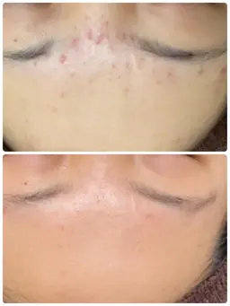 新規限定【REVIハーブピーリングお試し🌿】ニキビの無い肌へ✨300種類の酵素と植物幹細胞で肌が育つ