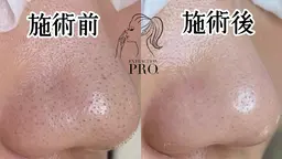 毛穴エクストラクションプロ 毛穴美人コース