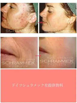 ドイツのエステ☆美容外科、皮膚科でも大人気☆グリーンピール5Days