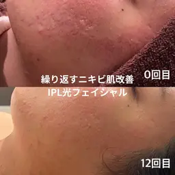 光フェイシャル|赤み・ニキビ跡・くすみ改善