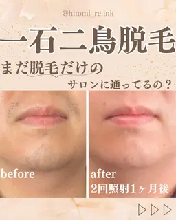 【急な予定にも対応】メンズひげ脱毛　鼻下/顎/顎下30分