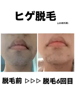 【毎朝のヒゲ剃り卒業✨時短＆清潔感UP😎🔥】 ヒゲ脱毛　通常6,000円→3,980円
