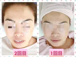 フォーカスネオ  次世代エステマシーン🌟｡:*