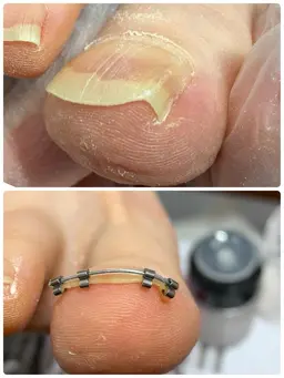 巻き爪矯正