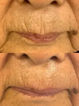 【艶玉】3種のフレッシュ幹細胞＋国産ハーブピーリング