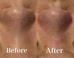 【先着10名限定！】毛穴洗浄体験🫧ツヤツヤお肌になりたい方にオススメ🧖🏻‍♀️🩵