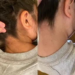 うなじ脱毛