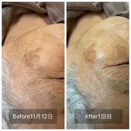 ☆プラズマ美容フェイシャル