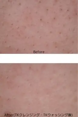 毛穴ケアモニター