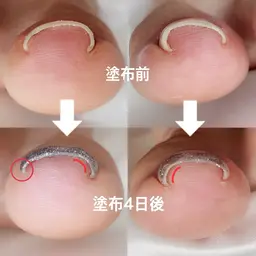 フットメニュー　➕　親指両足巻き爪矯正ジェル💗オフなし