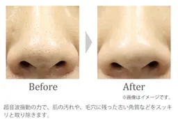 【毛穴ディープクレンジング(パック付)】ニキビ・いちご鼻🍓・お化粧崩れ、お化粧のりにお悩みの方に❣️✨️