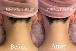 【2位🥈背中・うなじ脱毛✨¥11000→¥7700】(シェービング/角質ケア/保湿付)ご新規様限定🪽 回数:1回