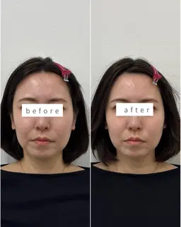 🌿モニター募集🌿20名限定💆🏻‍♀️【たるみを速攻リフトアップ✨むくみ、左右差改善】小顔矯正（カウンセリング込）