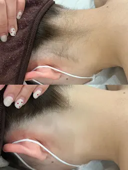 [綺麗な後ろ姿目指そう🦋]うなじ脱毛⭐️