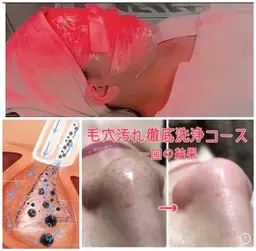 毛穴角栓洗浄吸引・黒ずみ対策ハイドラフェイシャル60分