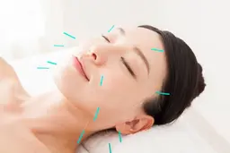 【花粉の季節限定】花粉鍼【鼻がむずむず、眠れない】