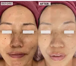 韓国最新エステ美肌ケア