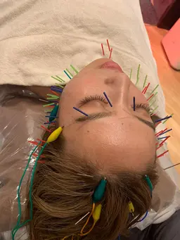 気になる毛穴開きもごっそり落とす🔥ハイドラ＋美容鍼🪡