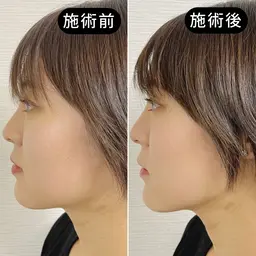 【左右差・ゆがみ改善】骨盤ケア×小顔美容鍼EMS 70分