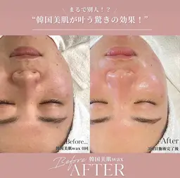 イベント前に顔脱毛💁‍♀️艶肌WAX🫧従来のフェイスWAXとは違い美容成分たっぷり♡つるんとした肌質へ艶爆誕✨