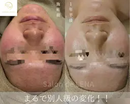 《顔◆最強ニキビケア》ハーブピーリング×アクネ菌ケア×鎮静×毛穴洗浄