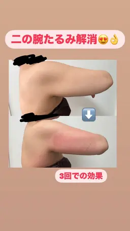 初回 お好きな箇所2カップ(下っ腹、内もも、二の腕、ふくらはぎにおすすめ)