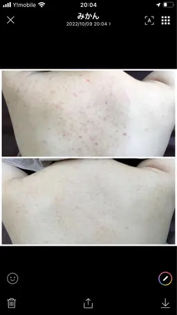 平日限定‼️ボディーハーブピーリング(剥離なし)※ハイドラ付🌿モニター募集 背中or二の腕orお尻orデコルテなど