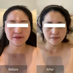 整形級小顔&ふっくらツヤ肌