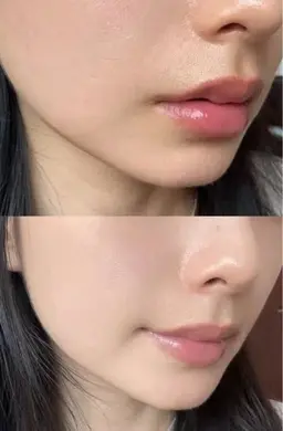 顔脱毛&DPLを同時にご施術/濃さに合わせて40分