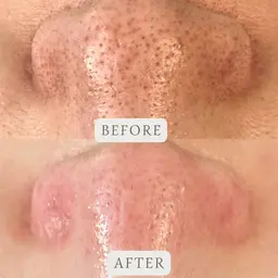 毛穴レス【汚れスッキリ&引き締め毛穴】毛穴洗浄＋毛穴マスクスチーム＋毛穴引き締めマシン💗